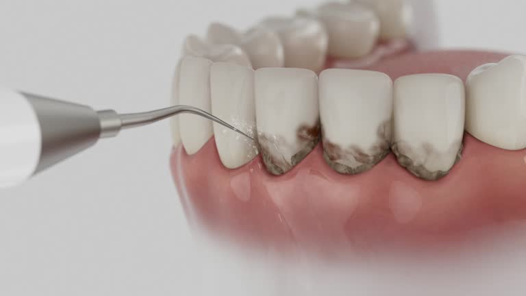 Reliable Wisdom Tooth Removal contractor in Walker County County, GA by Dentist Open Now